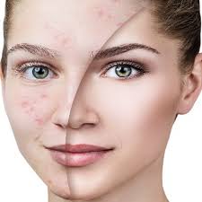 acne cosmetica