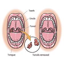 tonsillectomy medbroadcast com
