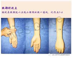 中医特色传统技术（一）】腕踝针：一针帮你止“痛” - 特色技术- 江门市中心医院