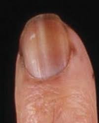 nails in systemic disease