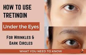 tretinoin for under eye circles