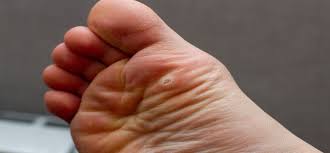 how to put plantar warts in your past