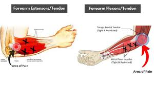 elbow pain during tricep extension