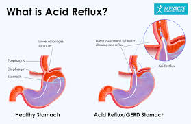 acid reflux after gastric sleeve