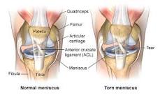 where-is-meniscus-pain-located