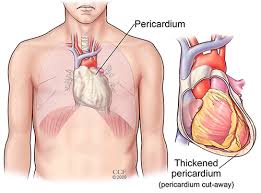 Time to call the er! Pericarditis Symptoms Causes Treatments