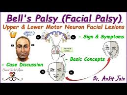 lower motor neuron palsy