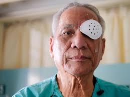 restrictions after cataract surgery