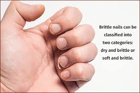 brittle nails causes symptoms