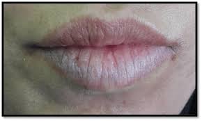 appearance of the lips at 15 days of