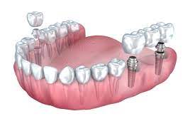 cost of dental implants asheville nc