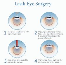 procedure laser eye surgery lasik