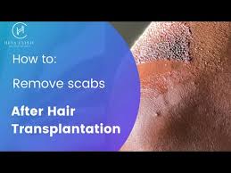 scabs after a hair transplant