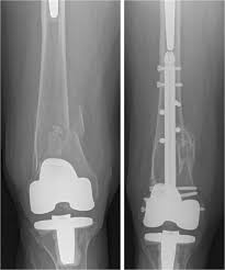 hip arthroplasty prosthesis