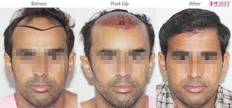 why hair transplant is considered a