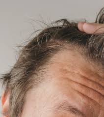 what causes hair loss baldness 3
