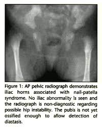 familial nail patella syndrome