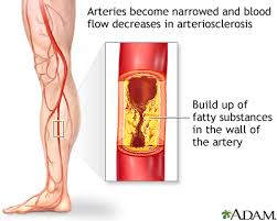 peripheral artery disease legs