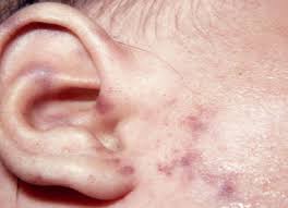 If so, it's likely they're actually suffering a viral infection called slapped cheek syndrome. Meningococcal Disease Kidshealth Nz