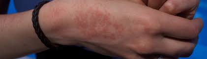Itchiness, especially at night, of as mentioned, you may develop rash on hands and feet due to a viral infection. Heat Rash Treatments Symptoms And Causes Healthdirect