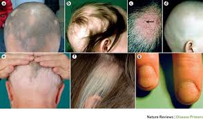 Risk factors include a family history of the condition. Alopecia Areata Nature Reviews Disease Primers
