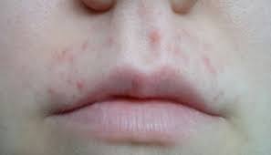 top lip waxing nightmare with pic mumsnet