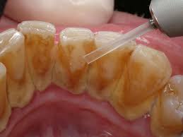tartar dental calculus complete tips