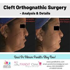 cleft orthognathic surgery ysis