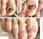 足の親指の爪が剥がれてしまった - 自爪ケアサロン横浜