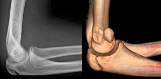 Did you know that the elbow is a synovial hinge joint? Medial Epicondylar Fractures Pediatric Pediatrics Orthobullets
