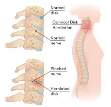 pinched shoulder blade nerve symptoms