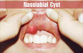nasol cyst causes symptoms