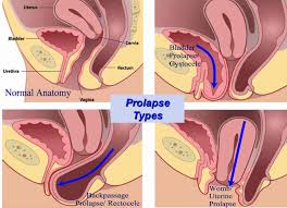 pelvic organ prolapse causes