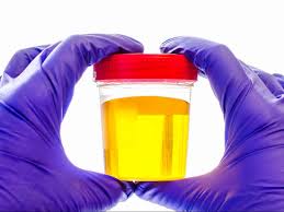 Bright Yellow Urine Colors Changes And Causes