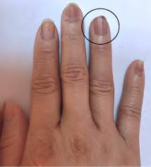 paaxel nail toxicity