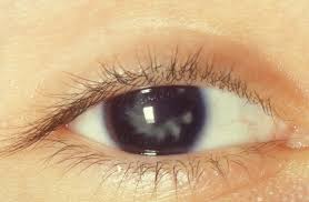 secondary cataract treatment and