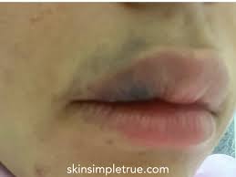 lip filler bruising