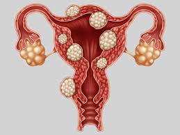 Endometriosis endometriosis happens when tissue similar to the lining of the uterus (womb) grows outside of the uterus. Endometriosis What Do You Need To Know Hirslanden