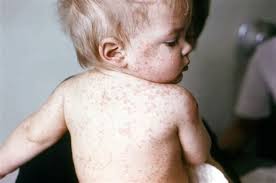home remes for measles in es