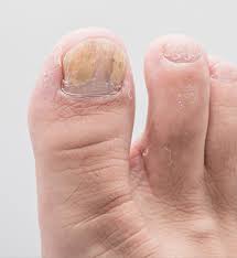 nail psoriasis richmond dermatology