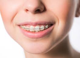 Ideally the upper incisors should be in front of the lower incisors where they overlap them by approx 2 mm. Overbite Correction How Long Does The Process Take Central Texas Orthodontics