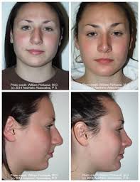 Nose job for wide nose bridge. Wide Nasal Bones Before And After Photo Gallery Nose Surgery Photos
