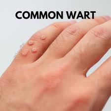 causes of warts and how to treat them