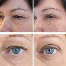 laser resurfacing of the eyelids after