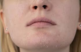 do you have dry skin around the mouth