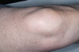 knee bursal dysfunction springerlink