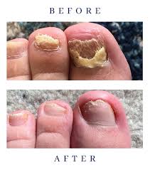 onychomycosis treatment toenail