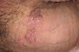 Kết quả hình ảnh cho genital warts