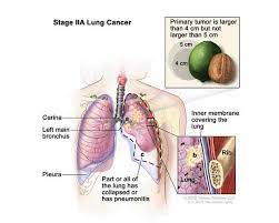 lung cancer medlineplus genetics
