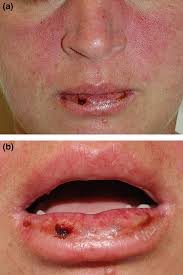 the lip in lupus erythematosus nico